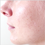 Akne_Ecoderm_Nachher Akne_Ecoderm_Nachher