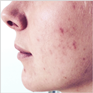 Akne_Ecoderm_Vorher Akne_Ecoderm_Vorher