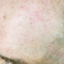 Aktinische Keratose_Nachher Aktinische Keratose_Nachher